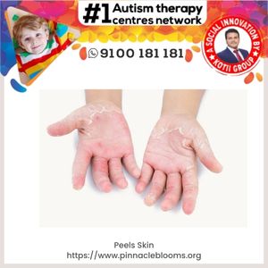 Understanding and Managing Skin Peeling Tantrums in Children with Autism